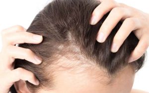 تونیک ضد شوره و کنترل کننده چربی مو تراست1